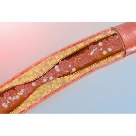 blocked blood vessel animation 3D model